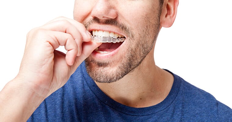 A male patient placing clear aligners into the mouth